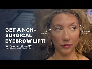 PDO Thread Brow Lift: Top 5 Things to Know