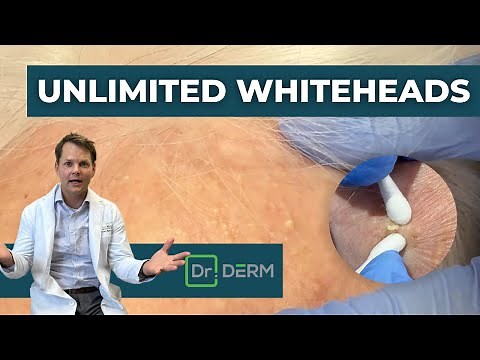 Unlimited Whiteheads! | Dr. Derm