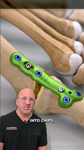 How Surgeons Grind-up Donor Bone to Heal Fractures #orthopedics