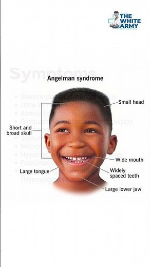 Angelman Syndrome