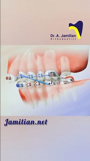 Upper Jaw Retraction Using First Molar Extraction #bracs #dentist #orthodontics #smile #extraction
