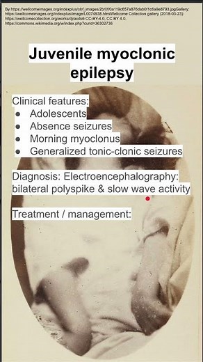 Juvenile myoclonic epilepsy