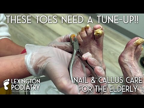 These Toes Need A Tune-up!! Nail & Callus Care for the Elderly