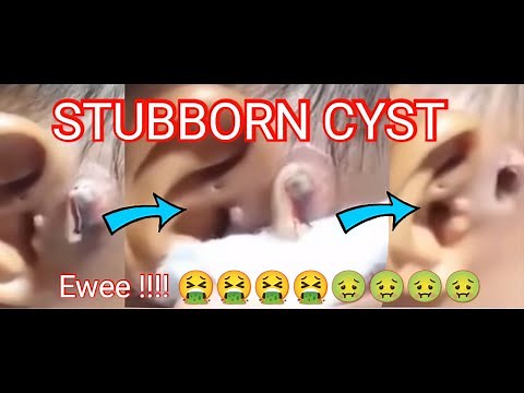 cyst popping 2021 satisfying