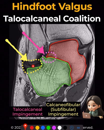 MSKMRI on Instagram: "[Coalition 36] Hindfoot Valgus in Tarsal Coalition – Radiology Perspective Tarsal coalition is strongly linked to hindfoot valgus, the key driver of rigid pes planovalgus (peroneal spastic flatfoot). Restricted subtalar motion alters biomechanics and leads to progressive deformity. Pathophysiology Restricted Subtalar Motion → abnormal biomechanics, rigid flatfoot, early OA. Peroneal Shortening/Spasm → protective contraction of peroneal muscles during inversion attempts. Pro