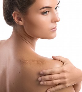 How To Get Rid Of Old Scars: 11 Effective Natural Remedies