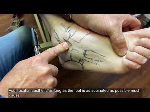 Topographical Anatomy of the Foot and Ankle Lateral Aspect and Nerves of the Foot and Ankle