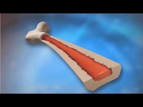 Multiple Myeloma - Mayo Clinic