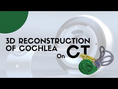 CT 3D reconstruction of cochlea