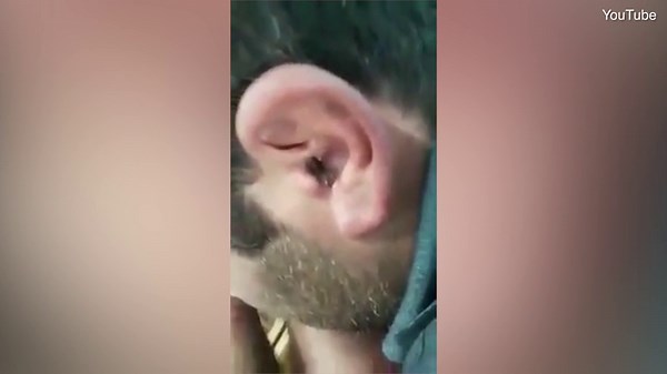 Video: Gruesome moment centipede is removed from man's ear | Daily Mail Online