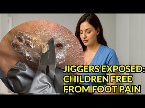 Jiggers Exposed: Children Pain-Free