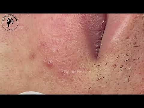 Brutal Cystic Acne Removal Around the Mouth — So Satisfying!
