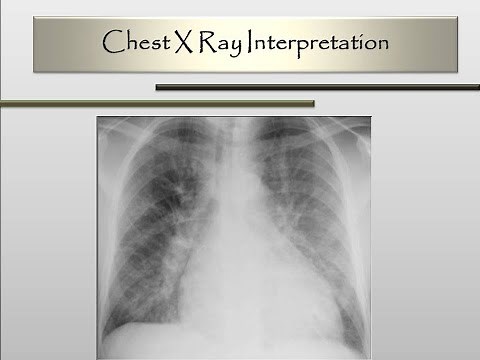 Chest X-Ray Interpretation