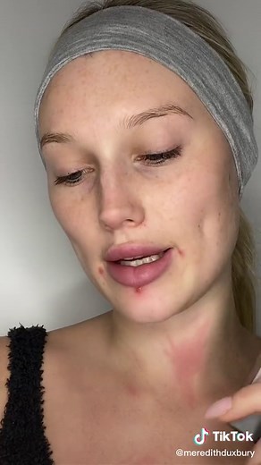 How to Conceal Acne with Makeup for Flawless Skin