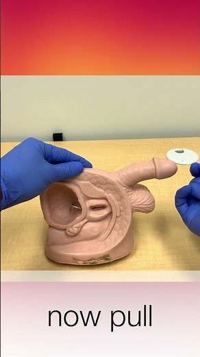 Removing Ureteral Stent in 15 Seconds #shorts