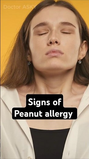 Signs of Peanut Allergy #Health #Science #Food