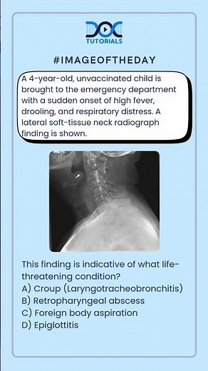 Life-Threatening Pediatric Emergency: Identifying Epiglottitis from Neck X-Ray Findings