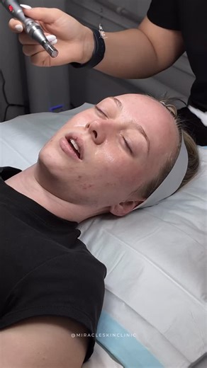Unlike traditional microneedling, Nano Infusion involves no needles, no discomfort, and absolutely no downtime — making it perfect for all skin types, including sensitive or reactive skin. It’s ideal for anyone wanting to target dryness, dullness, uneven tone, or simply maintain a healthy skin barrier between advanced treatments. At Miracle Skin Clinic, we focus on restoring skin balance through science-backed treatments that work in harmony with your skin — not against it. Experience the next g