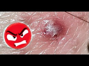 Inflamed Ingrown Hair