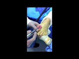 First Big Toe Joint Replacement Surgery with "Primus" Implant  • Video • MEDtube.net