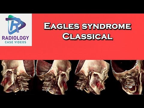 Eagles syndrome , Classical