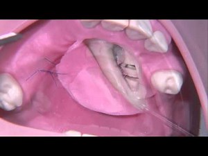 Operative removal of an impacted canine
