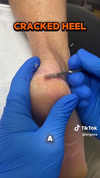 Treating Cracked Heels: Recovering Skin Health