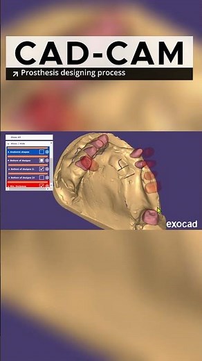 Dental Crowns in Making with CAD-CAM Exocad Software