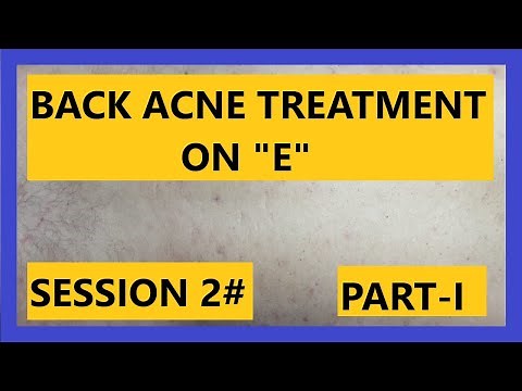 Back ACNE Treatment on "E" (SESSION #2) Part I