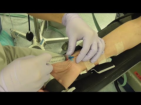 【ライン】動脈穿刺(Aライン)_貫通法