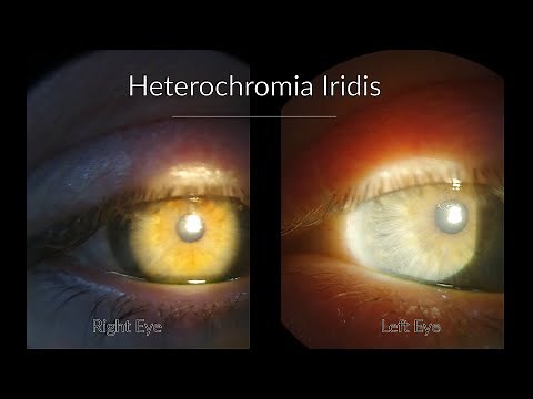 Fuchs Heterochromic Iridocyclitis - Ophthalmology cases