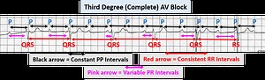 Differentiating Atrioventricular (AV) Blocks | ECGEDU.com