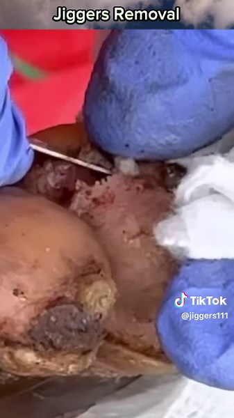 #jiggers #jiggersremoved #cleaning #asrm #pimple #popping