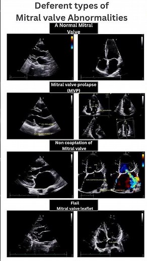 Mitral Valve – Normal vs. Prolapse vs. Non-Coaptation vs. Flail Leaflet