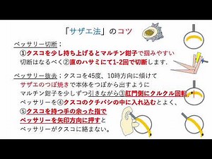 ソフトペッサリー サザエ法抜去のコツ How to remove vaginal pessary