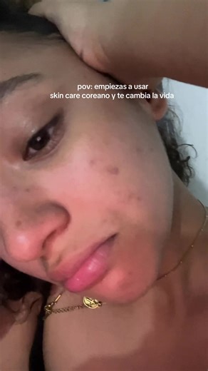 lo mejor que le ha pasado a mi piel ✨🩷y aprender a hacer limpiezas profundas también 😅#acne#acnetreatment#skincaretips#skincare