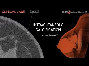 nu:view Breast CT: Visualization of Intracutaneous Calcification