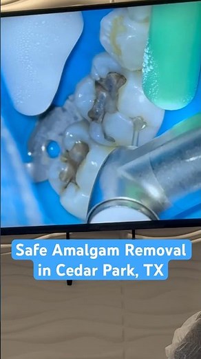 Safe Amalgam Filling Removal | Mercury-Free Dentistry in Cedar Park, TX