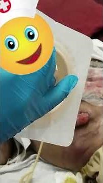 How to Change a Stoma Bag | Colostomy Care Step-by-Step (Nursing Skills)