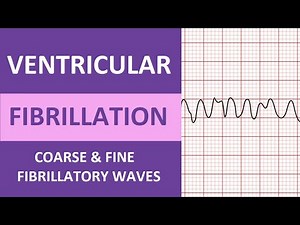 Ventricular Fibrillation (V-fib) Quiz Questions ECG/EKG
