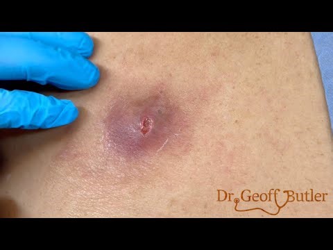 Reincision of an infected cyst that wasn’t drained properly.