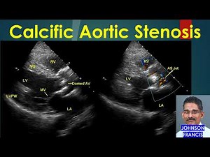 Calcific Aortic Stenosis Colour Doppler Echocardiogram
