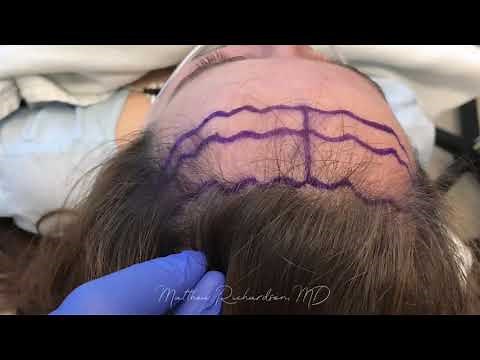 Forehead Reduction / Hairline Advancement with Before and After Photos - Dr. Matthew Richardson