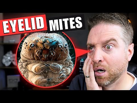How to Get Rid Of Eyelid Mites That Cause Demodex Blepharitis!