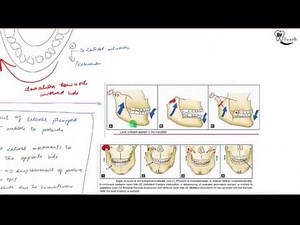 Condyle fracture- Oral surgery