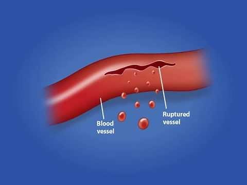 Inflammation Process
