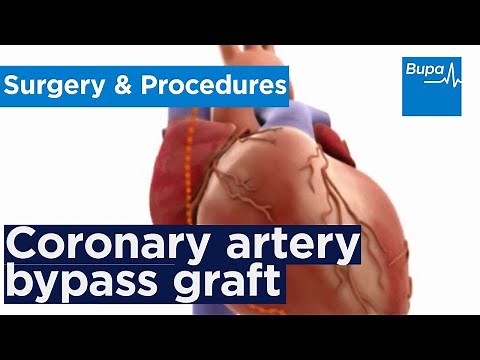 How coronary artery bypass graft (CABG) surgery is carried out | Bupa Health