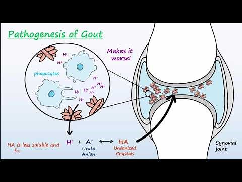 Gout - Mechanisms & Treatment