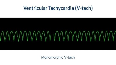ECG Interpretation: Lethal Arrhythmias