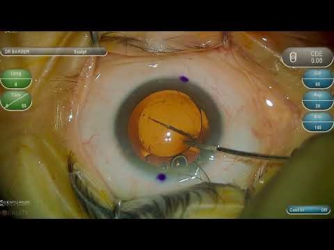 Surgery: IOL Exchange